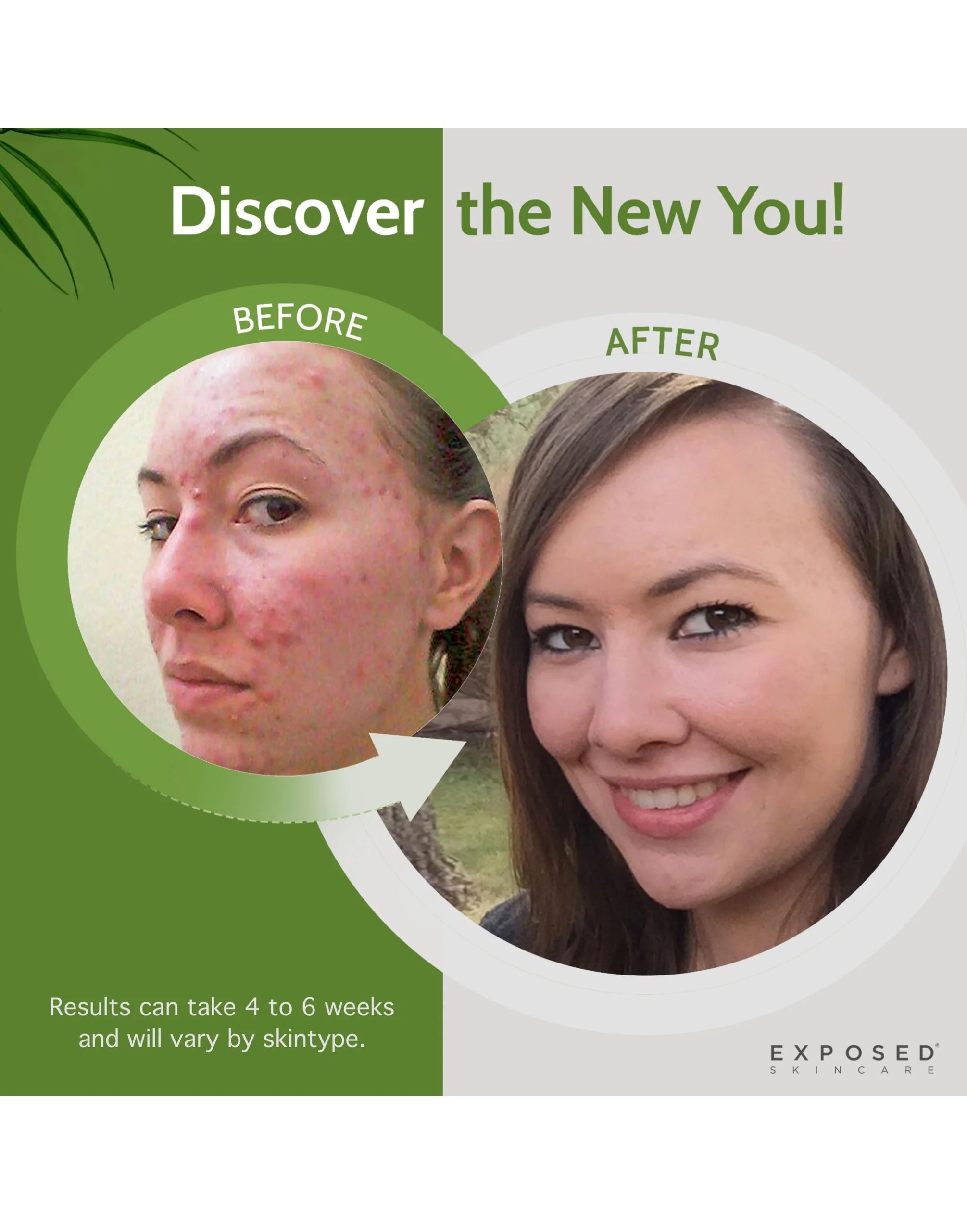 Alternative view of Clear Skin + HYDRATION Expanded Kit